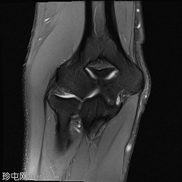 肘部滑膜皱襞综合征