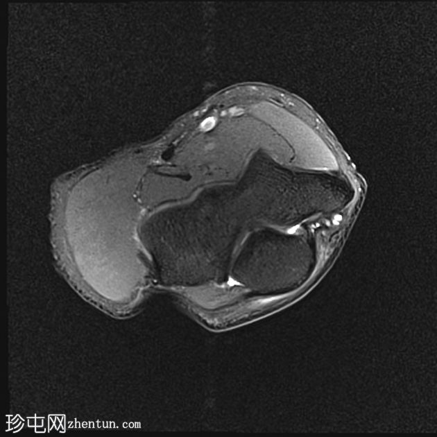 肘部滑膜皱襞综合征