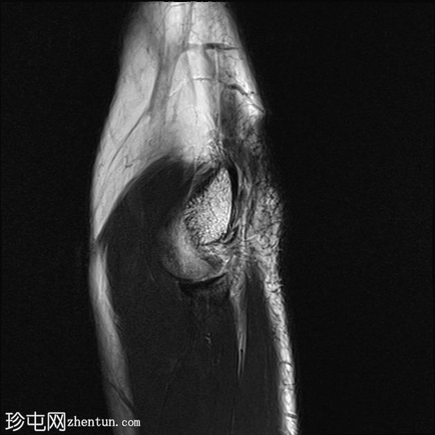 肘部滑膜皱襞综合征