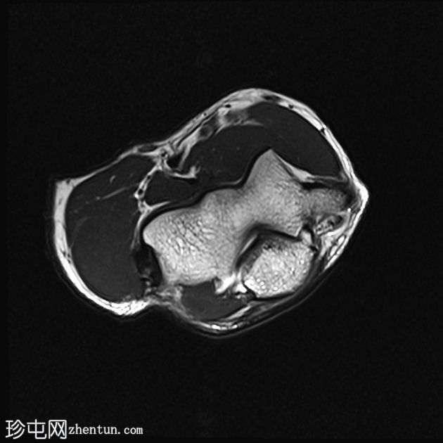 肘部滑膜皱襞综合征