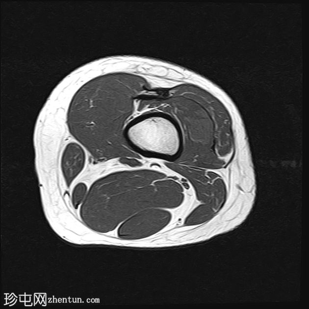 静脉血管畸形 - 大腿