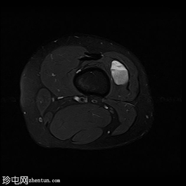 静脉血管畸形 - 大腿