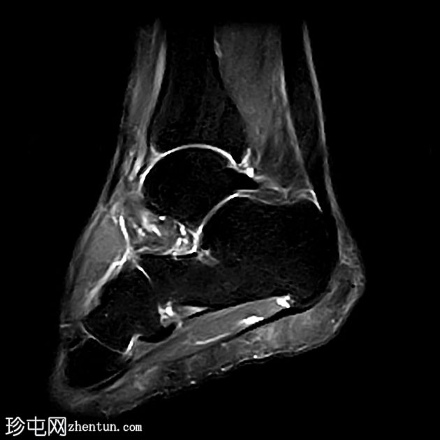 跟腱病伴腱鞘旁炎