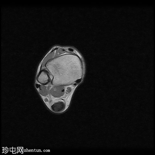 跟腱病伴腱鞘旁炎