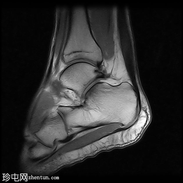 跟腱病伴腱鞘旁炎