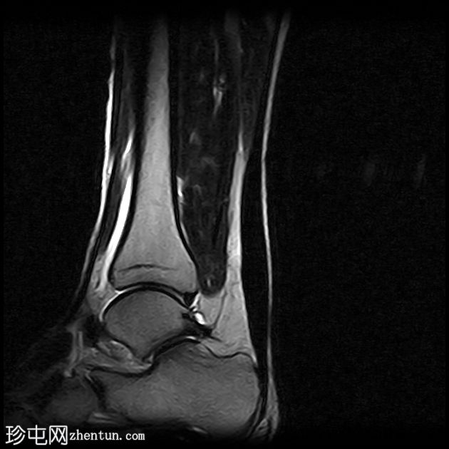 跟腱病伴腱鞘旁炎