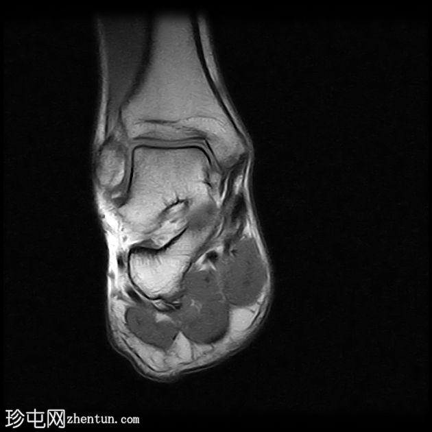 跟腱病伴腱鞘旁炎