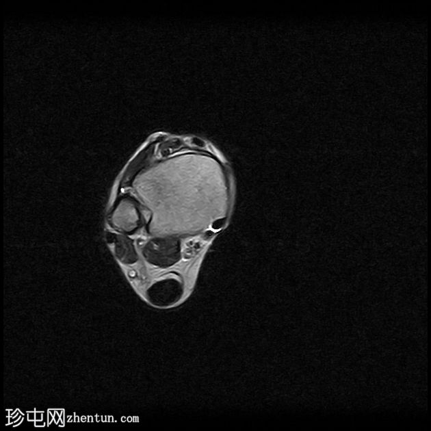 跟腱病伴腱鞘旁炎