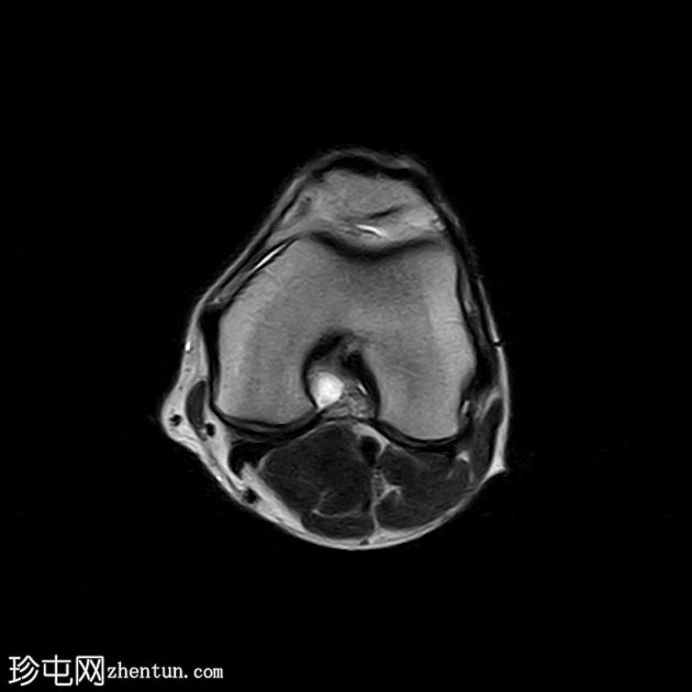 胫骨近端应力性骨折