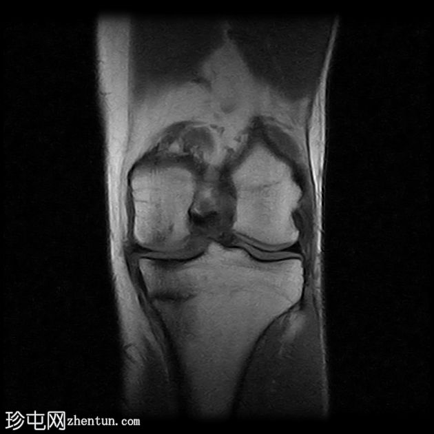 胫骨近端应力性骨折