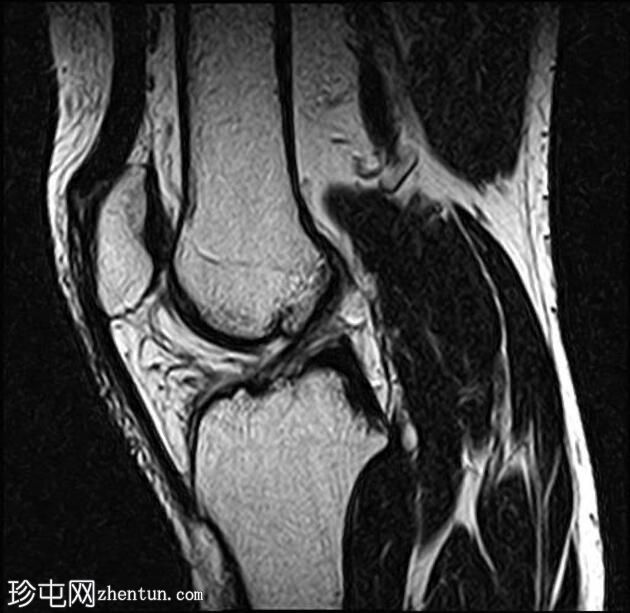 Hoffa脂肪垫腱鞘囊肿