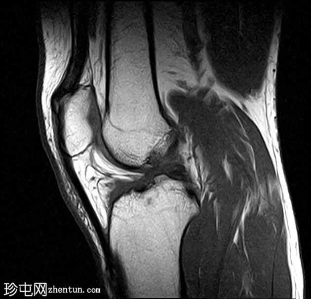 Hoffa脂肪垫腱鞘囊肿