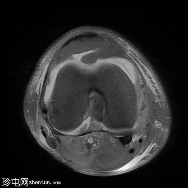 后交叉韧带撕脱骨折