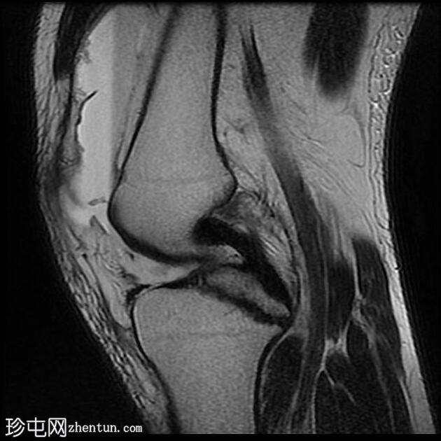 后交叉韧带撕脱骨折