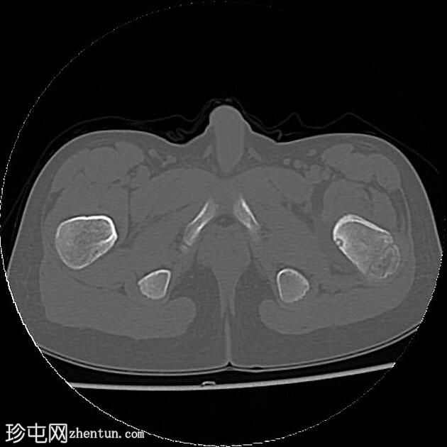 骨样骨瘤 - 股骨