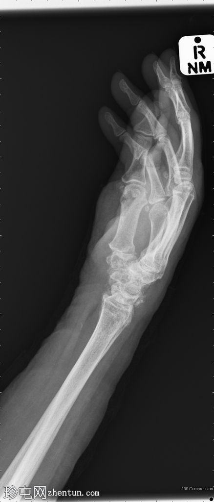 肘部和腕部焦磷酸钙沉积病（CPPD）