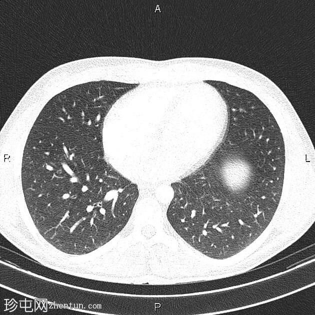 男性乳房发育症 (CT)