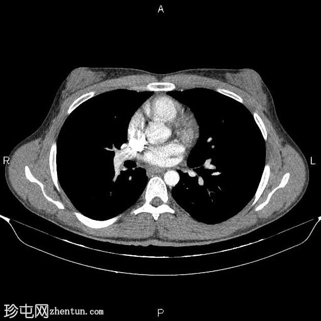 男性乳房发育症 (CT)