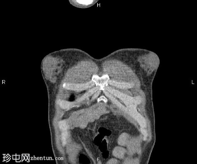 男性乳房发育症 (CT)