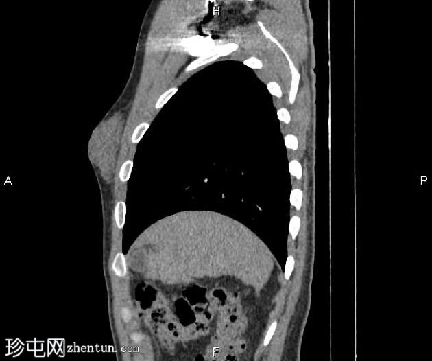 男性乳房发育症 (CT)