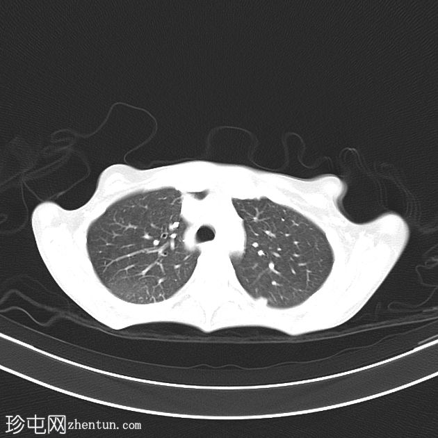 回肠末端结核