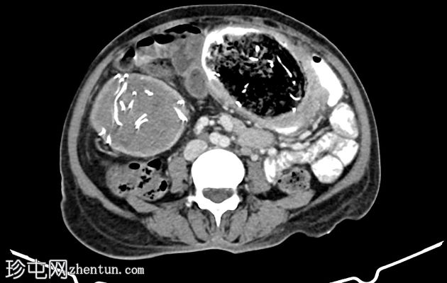 多发性腹盆腔纤维瘤