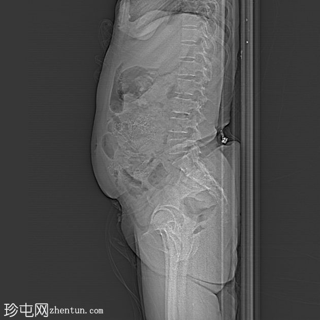 多发性腹盆腔纤维瘤