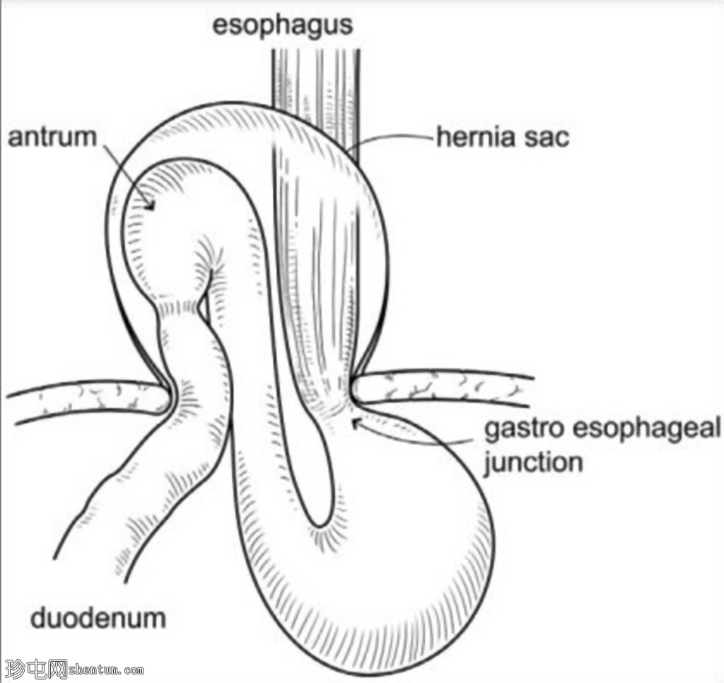食管旁疝伴胃窦部和十二指肠球部嵌顿