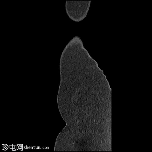 脾包膜下血肿