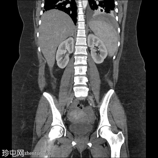 脾包膜下血肿