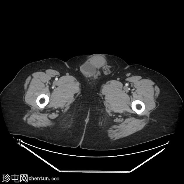 马蹄形胰腺