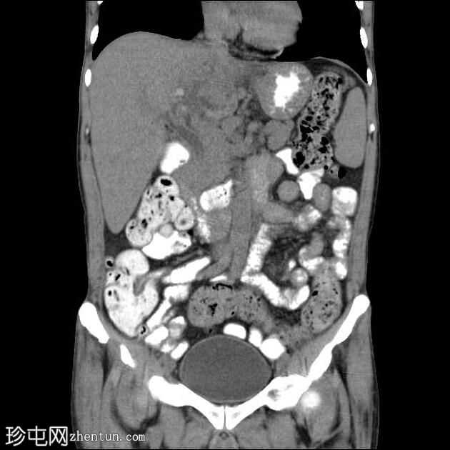 Klatskin 肿瘤 - 肝门部胆管癌