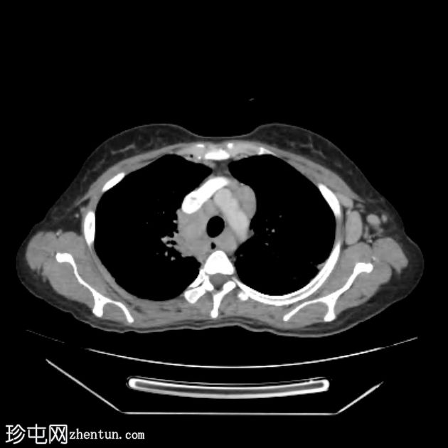 胸部和腹部类似淋巴瘤的结节病