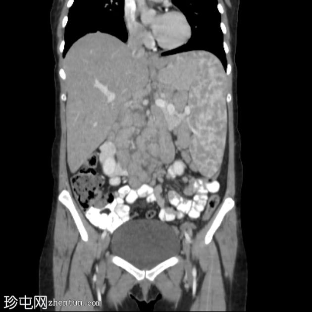 胸部和腹部类似淋巴瘤的结节病