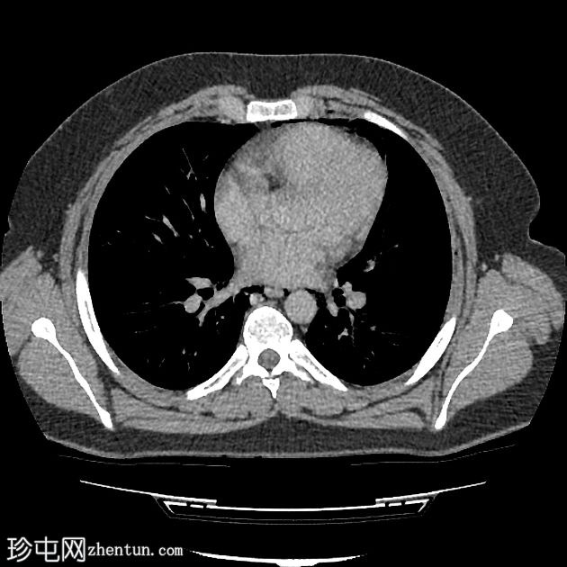 纵隔气肿