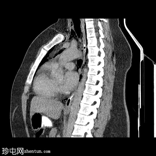 纵隔气肿