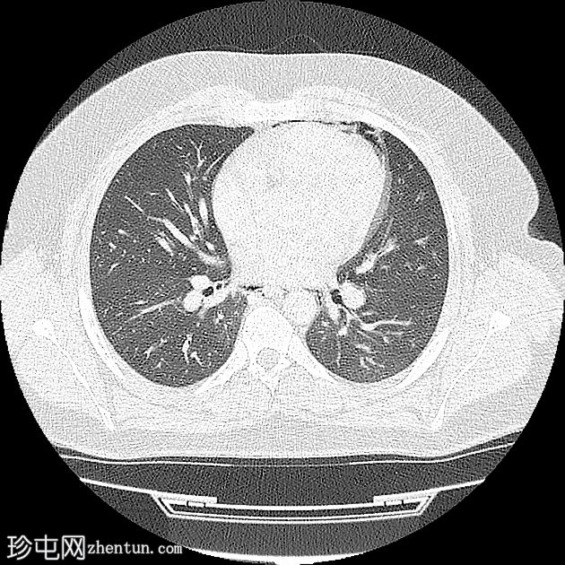 纵隔气肿