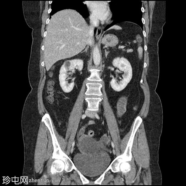 胆石性肠梗阻