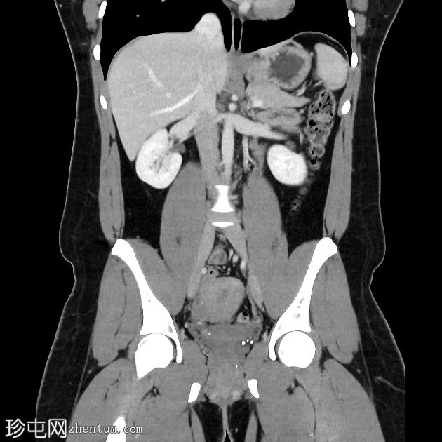 腹壁硬纤维瘤