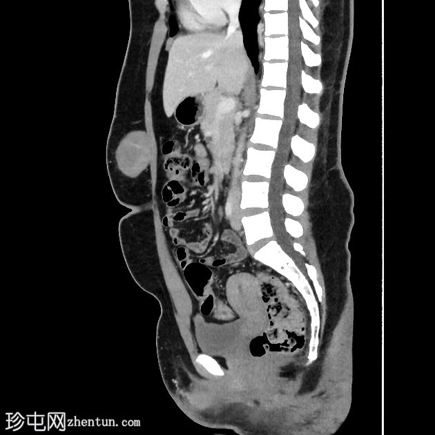 腹壁硬纤维瘤