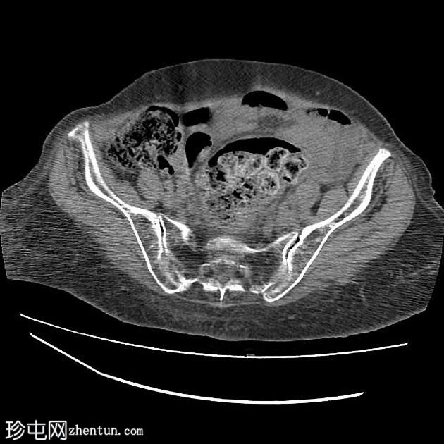 粪瘤伴粪结肠炎