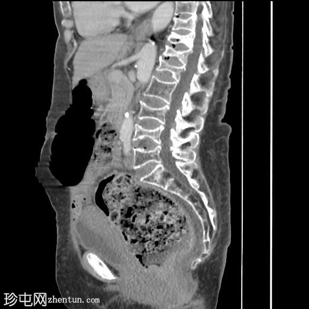 粪瘤伴粪结肠炎
