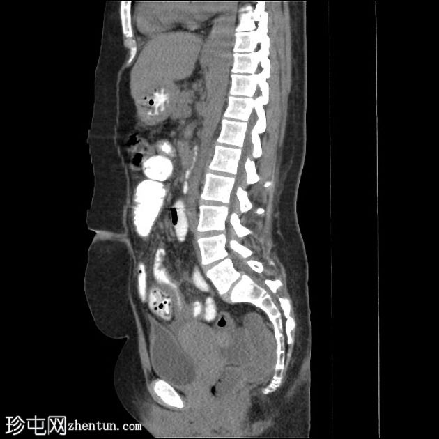 小肠梗阻的胃内球囊迁移