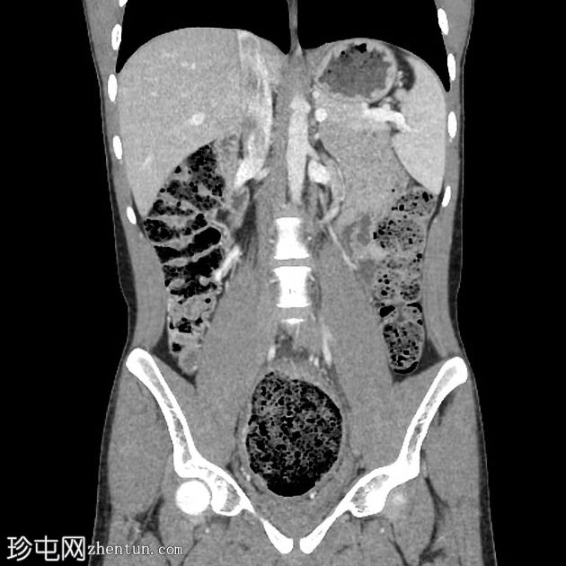 粪瘤伴粪结肠炎