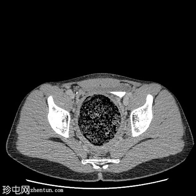粪瘤伴粪结肠炎