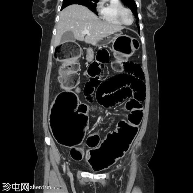 乙状结肠炎引起的大肠梗阻