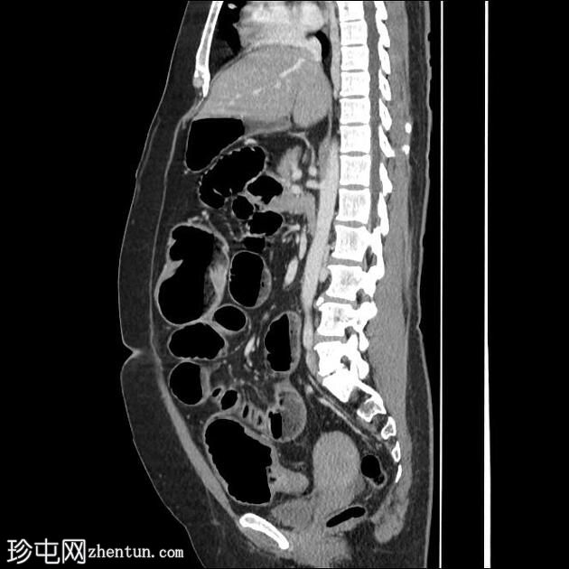 乙状结肠炎引起的大肠梗阻