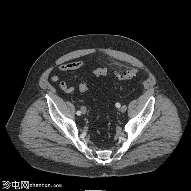 网膜梗死