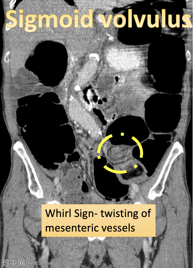 乙状结肠扭转