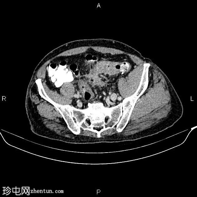 乙状结肠腺癌